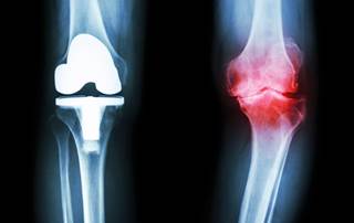None of the patients enrolled in the analysis exhibited signs or symptoms of complex regional pain syndrome in >2 of 4 subgroups. None of the patients enrolled in the analysis exhibited signs or symptoms of complex regional pain syndrome in >2 of 4 subgroups.