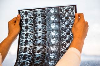 Ultrasound and MRI findings showed significant improvements in inflammatory lesions during treatment of PMR with tocilizumab. Ultrasound and MRI findings showed significant improvements in inflammatory lesions during treatment of PMR with tocilizumab.