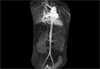 Infliximab May Lower Glucocorticoid Requirements, Lead to Remission in Takayasu Arteritis Infliximab May Lower Glucocorticoid Requirements, Lead to Remission in Takayasu Arteritis