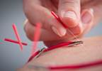 Pain Expectancy Affects Pain Experience After Electroacupuncture in OA Pain Expectancy Affects Pain Experience After Electroacupuncture in OA