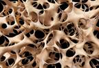Denosumab Increases Bone Mineral Density in Women With Primary Hyperparathyroidism Denosumab Increases Bone Mineral Density in Women With Primary Hyperparathyroidism
