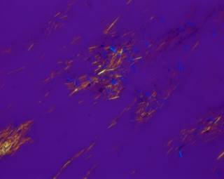 Polarized microscopic view of a scraping from a tophus, showing numerous negatively birefringent crystals consistent with monosodium urate. <i>Image courtesy of Dr Fields.</i> Polarized microscopic view of a scraping from a tophus, showing numerous negatively birefringent crystals consistent with monosodium urate. <i>Image courtesy of Dr Fields.</i>