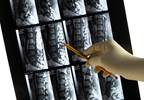 Pre-Op Chronic Opioid Use Ups Poor Outcomes Post Spinal Fusion Pre-Op Chronic Opioid Use Ups Poor Outcomes Post Spinal Fusion