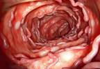 Guideline Issued for Treatment of Mild, Moderate Ulcerative Colitis Guideline Issued for Treatment of Mild, Moderate Ulcerative Colitis