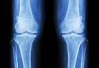 Early Radiographic Knee OA to Joint Arthroplasty: Factors of Structural Progression Early Radiographic Knee OA to Joint Arthroplasty: Factors of Structural Progression