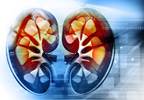 Acute Kidney Injury Increases Risks for CKD, ESRD, and Mortality Acute Kidney Injury Increases Risks for CKD, ESRD, and Mortality