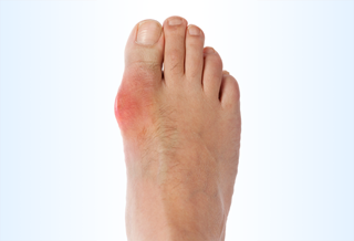 Only about half of patients with hyperuricemia went on to develop clinically evident gout. Only about half of patients with hyperuricemia went on to develop clinically evident gout.