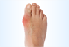 High Gout Burden Found Among Solid Organ Transplant Recipients High Gout Burden Found Among Solid Organ Transplant Recipients