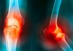 Does Cold Weather Affect Arthritis and Joint Pain? Does Cold Weather Affect Arthritis and Joint Pain?