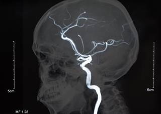 There may be a lower risk for ischemic stroke in patients with RA receiving methotrexate. There may be a lower risk for ischemic stroke in patients with RA receiving methotrexate.