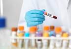 Autoimmune Reactivity to Malondialdehyde in SLE Linked to High Disease Activity, Lupus Nephritis Autoimmune Reactivity to Malondialdehyde in SLE Linked to High Disease Activity, Lupus Nephritis