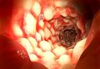 Glucocorticoids Linked to Significant Bone Deficit in Pediatric Crohn Disease Glucocorticoids Linked to Significant Bone Deficit in Pediatric Crohn Disease