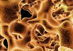 Increased Bone Formation in Osteoporosis With Teriparatide vs Zoledronic Acid Increased Bone Formation in Osteoporosis With Teriparatide vs Zoledronic Acid