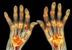 Sirukumab Effective in Rheumatoid Arthritis Refractory to Methotrexate or Sulfasalazine Sirukumab Effective in Rheumatoid Arthritis Refractory to Methotrexate or Sulfasalazine