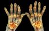 Sirukumab Effective in Rheumatoid Arthritis Refractory to Methotrexate or Sulfasalazine Sirukumab Effective in Rheumatoid Arthritis Refractory to Methotrexate or Sulfasalazine