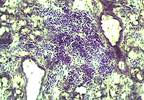 Expert Insight: A Closer Look at Neurological Manifestations of Sjogren Syndrome Expert Insight: A Closer Look at Neurological Manifestations of Sjogren Syndrome
