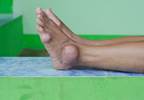 Allopurinol Dose Escalation May Not Improve Survival in Patients With Gout Allopurinol Dose Escalation May Not Improve Survival in Patients With Gout