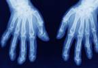 Secukinumab Improves Symptoms, Inhibits Radiographic Progression in Psoriatic Arthritis Secukinumab Improves Symptoms, Inhibits Radiographic Progression in Psoriatic Arthritis