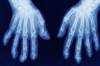 Radiographic Changes in PsA: Conventional Synthetic DMARDs vs Anti-TNF Therapy Radiographic Changes in PsA: Conventional Synthetic DMARDs vs Anti-TNF Therapy