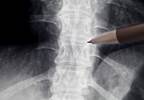 Spinal Radiographic Progression May Be Observed Early in Disease Course for axSpA Spinal Radiographic Progression May Be Observed Early in Disease Course for axSpA