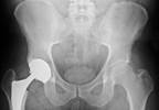 Higher Preoperative Disease Activity Linked to RA Flares After Arthroplasty Higher Preoperative Disease Activity Linked to RA Flares After Arthroplasty