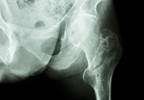 Thiazide Diuretic Use May Reduce Risk for Bone Fracture Thiazide Diuretic Use May Reduce Risk for Bone Fracture