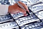 Ixekizumab Tops Placebo in Axial Spondyloarthritis Ixekizumab Tops Placebo in Axial Spondyloarthritis