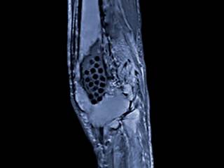 Chronic nonbacterial osteomyelitis or chronic recurrent multifocal osteomyelitis can present with a range of associated clinical manifestations. <i>Credit: Apogee/Science Source</i> Chronic nonbacterial osteomyelitis or chronic recurrent multifocal osteomyelitis can present with a range of associated clinical manifestations. <i>Credit: Apogee/Science Source</i>