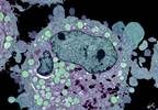 Addressing the Increased Risk for Malignancy in Rheumatoid Arthritis Addressing the Increased Risk for Malignancy in Rheumatoid Arthritis