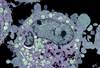 Addressing the Increased Risk for Malignancy in Rheumatoid Arthritis Addressing the Increased Risk for Malignancy in Rheumatoid Arthritis