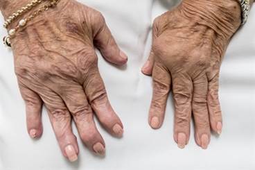 Inflammation: Is It the Link Between Rheumatoid Arthritis and Depression? Inflammation: Is It the Link Between Rheumatoid Arthritis and Depression?