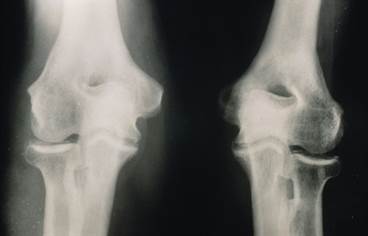 Examining Unmet Needs of Joint Disease Associated With Calcium Pyrophosphate Crystal Deposition Examining Unmet Needs of Joint Disease Associated With Calcium Pyrophosphate Crystal Deposition