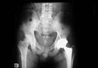 Oral Risedronate May Reduce Bone Resorption After Total Hip Arthroplasty Oral Risedronate May Reduce Bone Resorption After Total Hip Arthroplasty