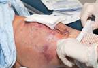 Late-Life Mobility Limitations Linked to Obesity After Arthroplasty for OA in Women Late-Life Mobility Limitations Linked to Obesity After Arthroplasty for OA in Women
