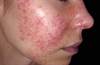Clinician Roundtable: Improving Quality of Life in Systemic Lupus Erythematosus Clinician Roundtable: Improving Quality of Life in Systemic Lupus Erythematosus