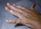 Alternative Measurement of Psoriasis Severity Effective in CZP-Treated Psoriatic Arthritis Alternative Measurement of Psoriasis Severity Effective in CZP-Treated Psoriatic Arthritis