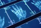 Original vs Expanded Disease Activity Scoring System in JIA Examined Original vs Expanded Disease Activity Scoring System in JIA Examined