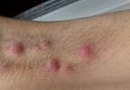 High Rate of Hidradenitis Suppurativa Observed in Patients With Axial Spondyloarthritis High Rate of Hidradenitis Suppurativa Observed in Patients With Axial Spondyloarthritis