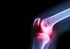 Efficacy, Safety of OnabotulinumtoxinA Assessed for Knee OA Treatment Efficacy, Safety of OnabotulinumtoxinA Assessed for Knee OA Treatment