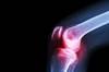 Efficacy, Safety of OnabotulinumtoxinA Assessed for Knee OA Treatment Efficacy, Safety of OnabotulinumtoxinA Assessed for Knee OA Treatment
