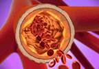 Aortic Vascular Inflammation Associated With CAD in Psoriasis Aortic Vascular Inflammation Associated With CAD in Psoriasis