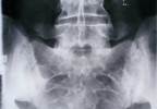 Reduced Structural Damage in Early Axial Spondyloarthritis Linked to Increased IL-31 Levels Reduced Structural Damage in Early Axial Spondyloarthritis Linked to Increased IL-31 Levels