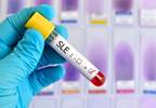 Anti-dsDNA Antibodies Correlated With Clinical, Laboratory Parameters in SLE Anti-dsDNA Antibodies Correlated With Clinical, Laboratory Parameters in SLE