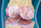 The Reliable Change Index: A Novel Approach to Estimate Osteoarthritis Progression The Reliable Change Index: A Novel Approach to Estimate Osteoarthritis Progression