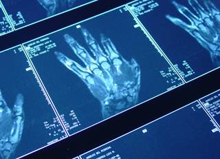 Targeting absence of MRI bone marrow edema in addition to a treat-to-target strategy had no effect on clinical and radiographic outcomes. Targeting absence of MRI bone marrow edema in addition to a treat-to-target strategy had no effect on clinical and radiographic outcomes.