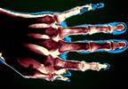 RA Associated With Greater Reduction in Short-Term Disease Burden vs Osteoarthritis RA Associated With Greater Reduction in Short-Term Disease Burden vs Osteoarthritis