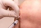 Optical Fiber Infrared Spectroscopy Identifies Septic vs Nonseptic Synovial Fluids Optical Fiber Infrared Spectroscopy Identifies Septic vs Nonseptic Synovial Fluids