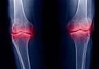 Radiographic Changes of Osteoarthritis Associated With Persistent Knee Pain Radiographic Changes of Osteoarthritis Associated With Persistent Knee Pain