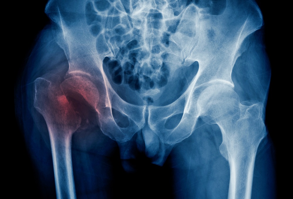 hba1c-corrected-frax-score-may-better-predict-fracture-risk-in-type-2