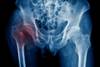 Serotonin Levels Predict Increased Risk for Hip Fracture, Nonvertebral Osteoporotic Fracture Serotonin Levels Predict Increased Risk for Hip Fracture, Nonvertebral Osteoporotic Fracture